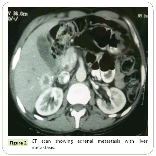 molecular-biology-and-biotechnology-metastasis