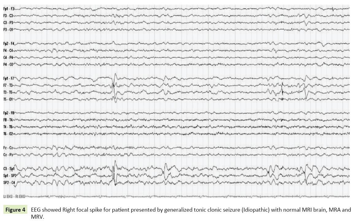 neurological-science-tonic-clonic-seizure