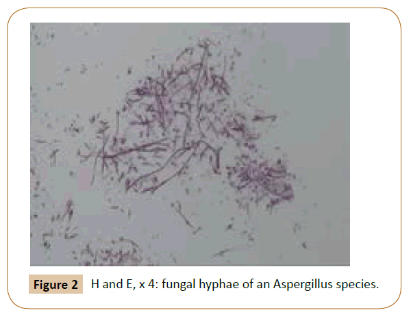 oncopathology-clinical-research-fungal-hyphae