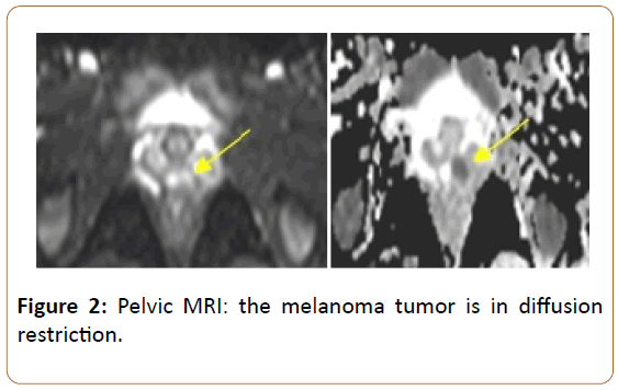 oncopathology-clinical-research-melanoma-tumor