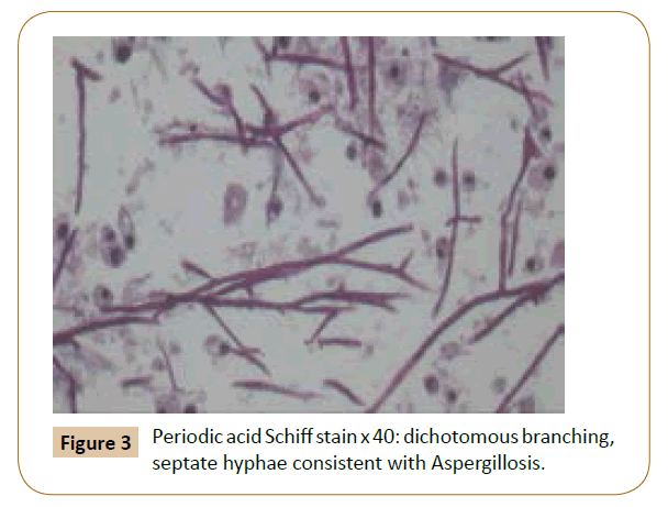 oncopathology-clinical-research-septate-hyphae
