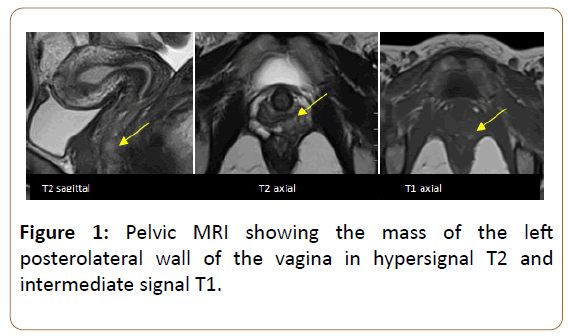oncopathology-clinical-research-vagina-hypersignal