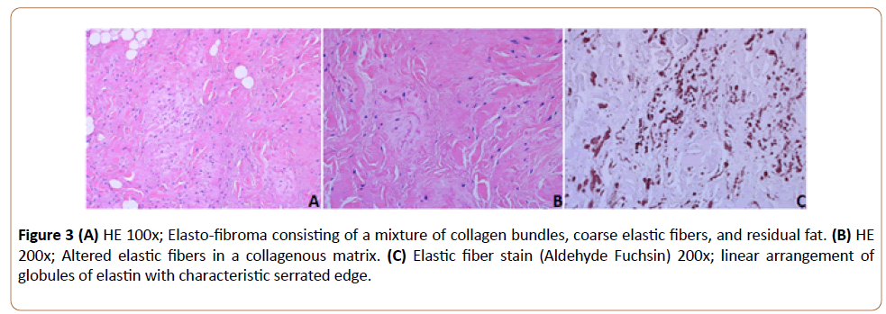 orthopaedic-disorders-fibroma