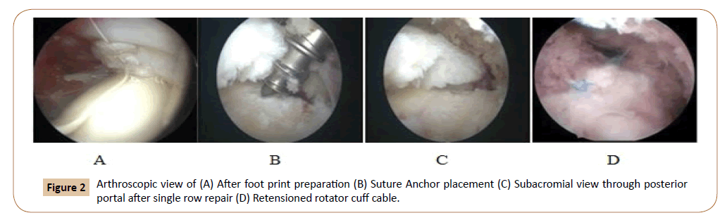 orthopaedic-disorders-subacromial