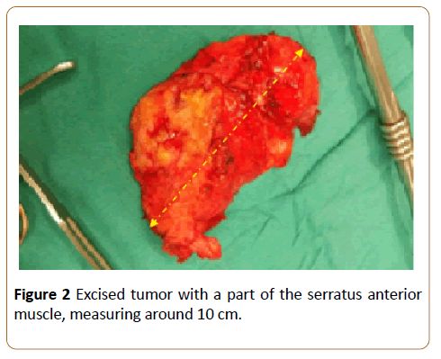 orthopaedic-disorders-tumor