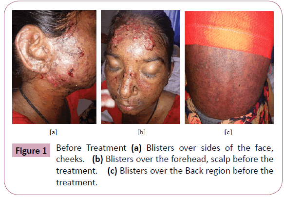 pharmacology-pharmacotherapeutics-Blisters