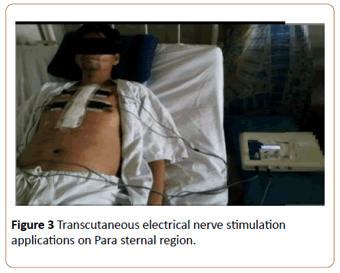 physiotherapy-research-electrical-nerve