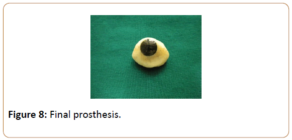 prosthetics-and-orthotics-open-journal-Final-prosthesis