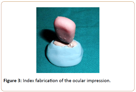 prosthetics-and-orthotics-open-journal-Index-fabrication