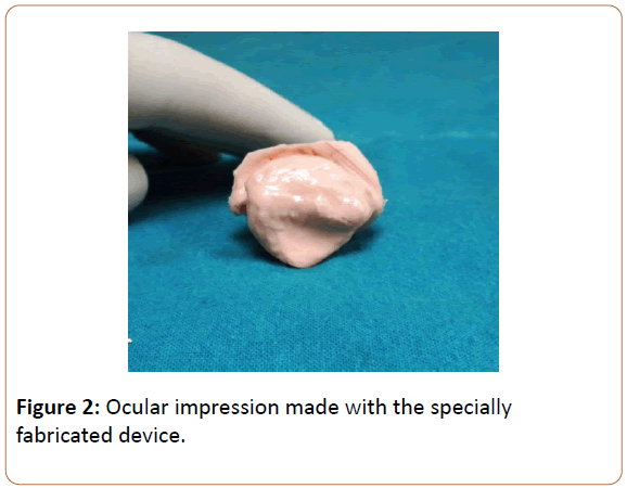 prosthetics-and-orthotics-open-journal-Ocular-impression
