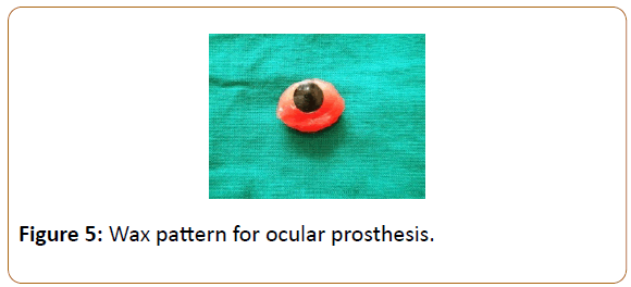 prosthetics-and-orthotics-open-journal-ocular-prosthesis