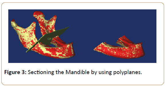 prosthetics-and-orthotics-open-journal-using-polyplanes