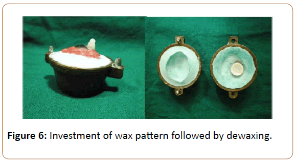 prosthetics-and-orthotics-open-journal-wax-pattern