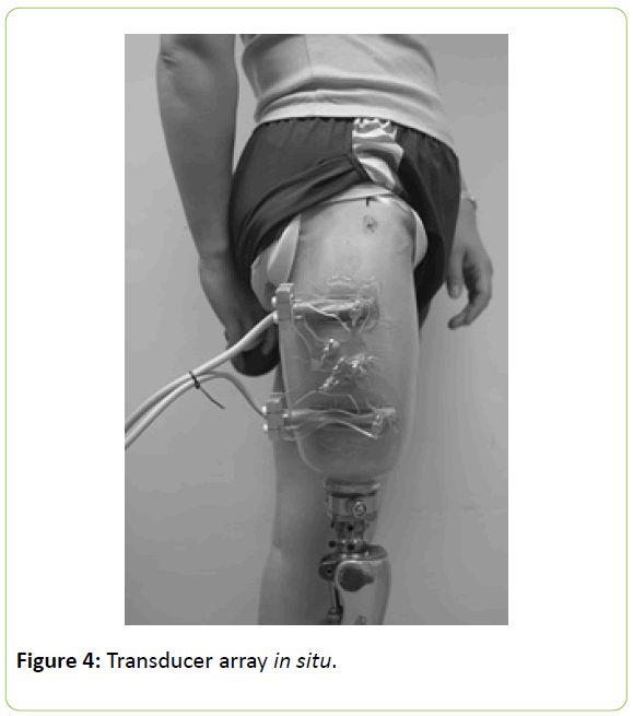 prosthetics-orthotics-Transducer-array-situ