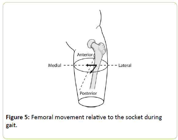 prosthetics-orthotics-movement-relative-socket