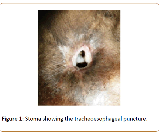 prosthetics-orthotics-open-journal-Stoma-showing