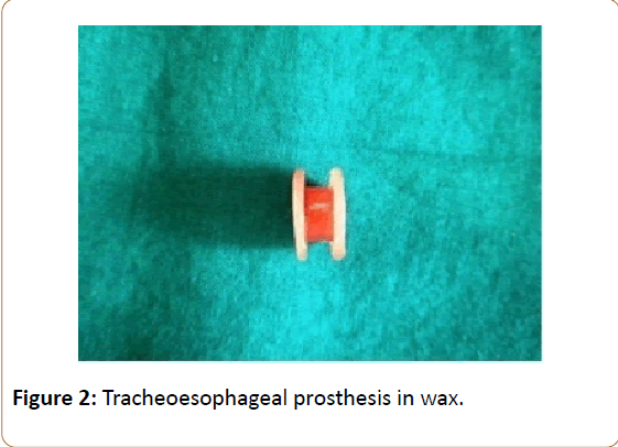 prosthetics-orthotics-open-journal-Tracheoesophageal-prosthesis