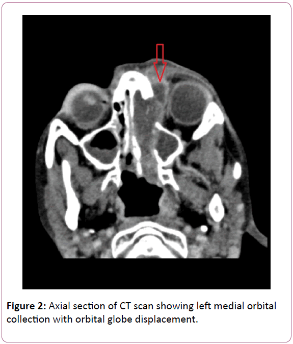 research-journal-of-ear-nose-andthroat-globe-displacement