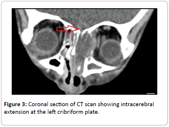 research-journal-of-ear-nose-andthroat-intracerebral-extension