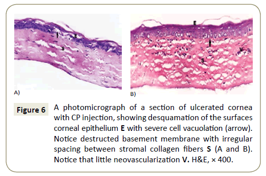 stem-cell-biology-and-transplantation-ulcerated