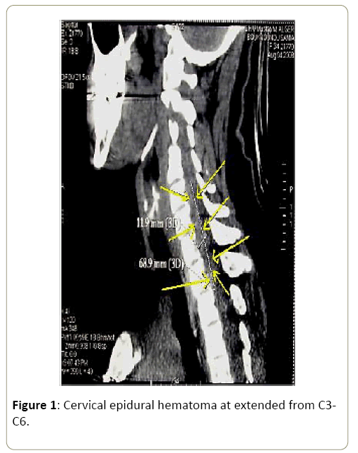 surgery-and-emergency-medicine-epidural