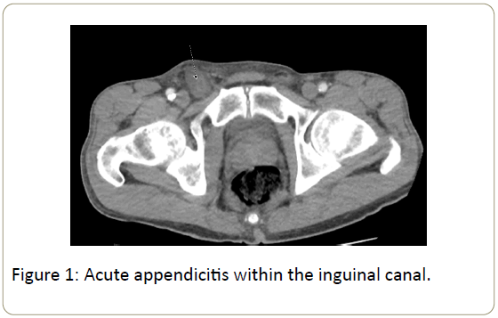 surgery-emergency-medicine-appendicitis-inguinal