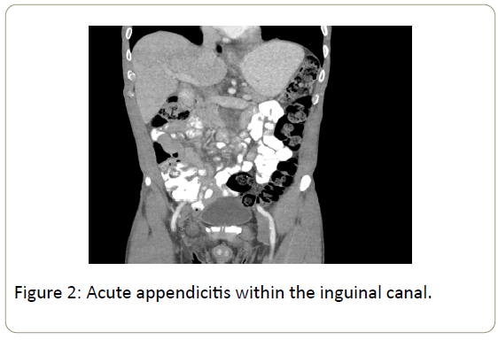 surgery-emergency-medicine-appendicitis-inguinal