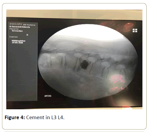 surgery-emergency-medicine-cement-2-2-19-g004