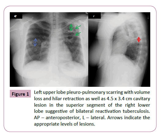 transmitted-diseases-and-immunity-pulmonary