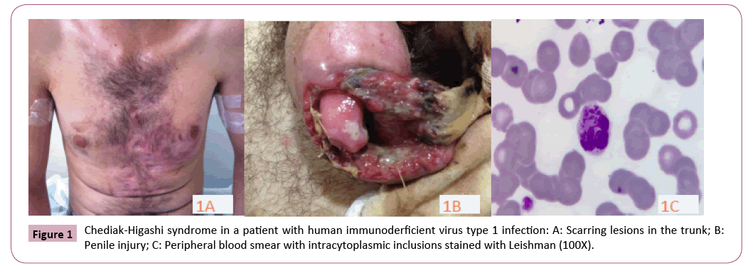 transmitted-diseases-immunity-immunoderficient