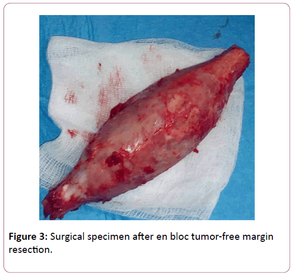 trauma-orthopedic-nursing-Surgical-specimen