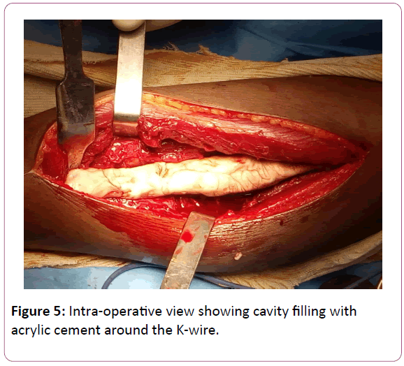 trauma-orthopedic-nursing-acrylic-cement