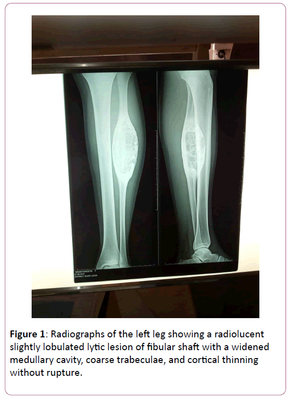 trauma-orthopedic-nursing-fibular-shaft