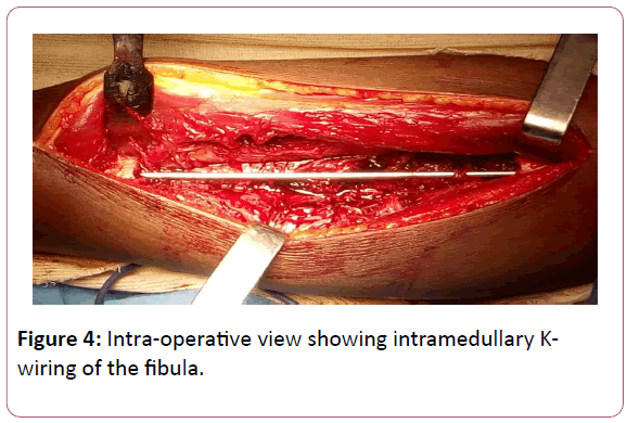 trauma-orthopedic-nursing-intramedullary