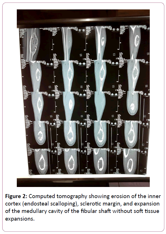 trauma-orthopedic-nursing-sclerotic-margin