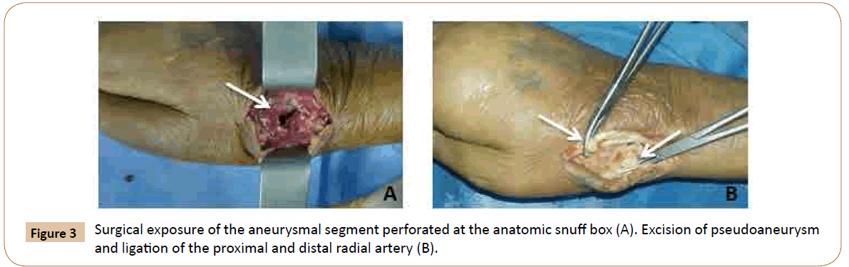 vascular-endovascular-therapy-anatomic-snuff