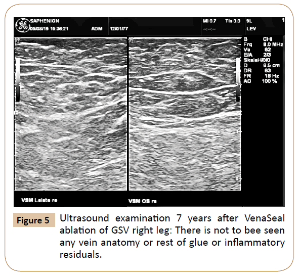 vascular-endovascular-therapy-bee-seen