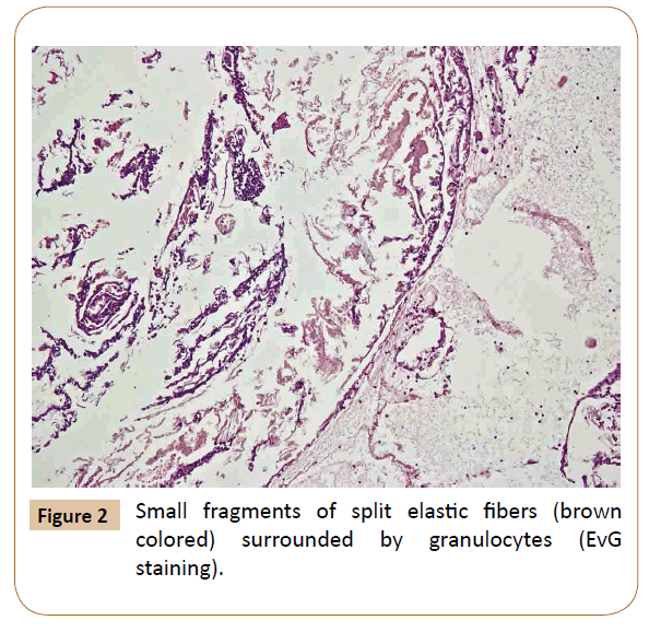 vascular-endovascular-therapy-elastic-fibers