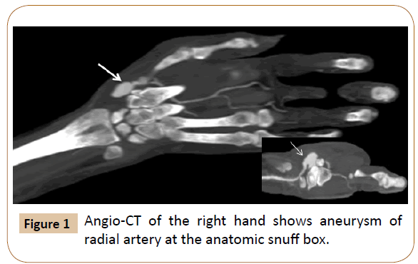 vascular-endovascular-therapy-snuff-box