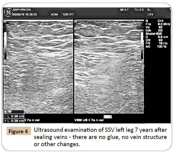 vascular-endovascular-therapy-vein-structure