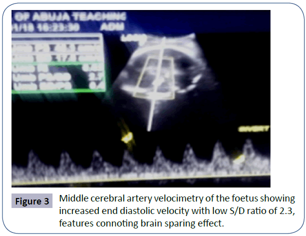 womens-health-reproductive-medicine-diastolic-velocity